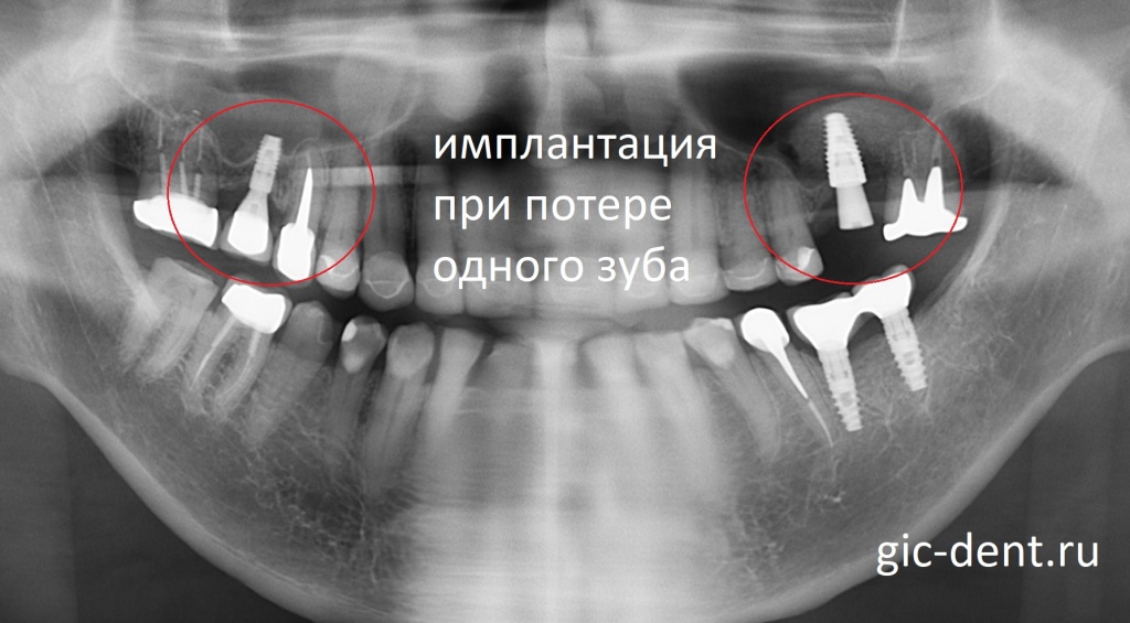Имплантация в случае потери одного зуба проходит проще, чем при многочисленной потере зубов